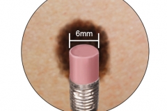 Melanoma