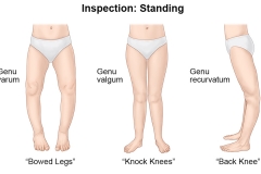 Abnormal Gait