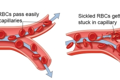 Sickel Cell Anemia